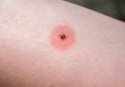 A Mysterious Illness Triggered by an Insect Bite Has Scientists Stumped