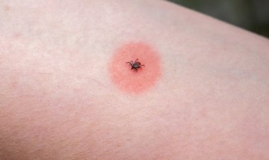 A Mysterious Illness Triggered by an Insect Bite Has Scientists Stumped