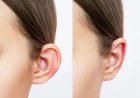 Get Perfectly Shaped Ears with Ear Reshaping in Islamabad
