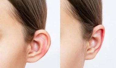 Get Perfectly Shaped Ears with Ear Reshaping in Islamabad