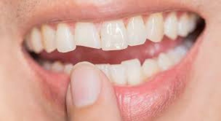 Chipped Crown Tooth Solutions You Can Trust