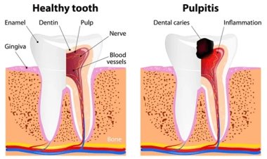 Understanding Irreversible Pulpitis: Causes and Symptoms