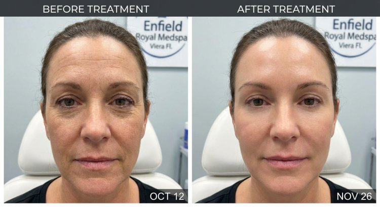 Botox Treatment Explained: A Practical Guide for Patients Considering Care in Viera