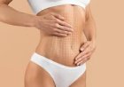 Transform Your Confidence with Liposuction in Dubai