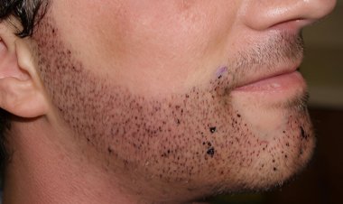Choosing the Best Clinic for Beard Hair Transplant in Islamabad