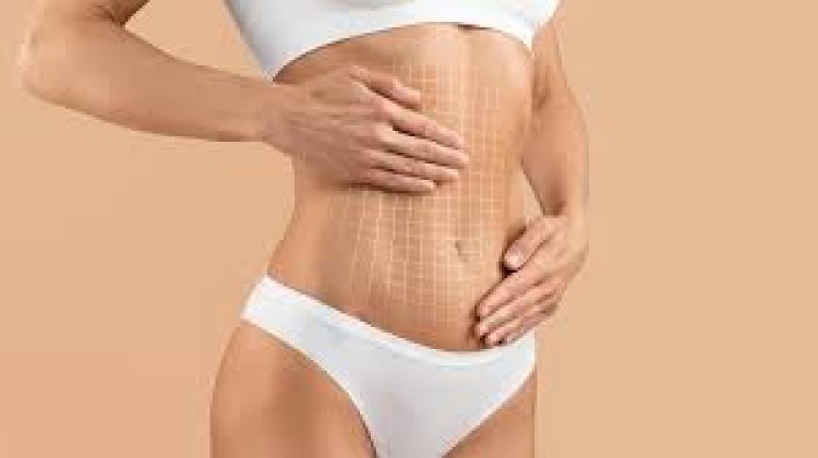 Vaser Liposuction in Dubai: What to Expect from Consultation to Results