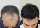 Natural Hair Restoration with Hair Transplant in Islamabad