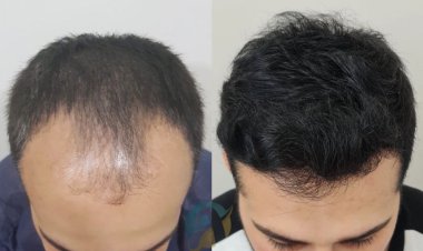 Natural Hair Restoration with Hair Transplant in Islamabad