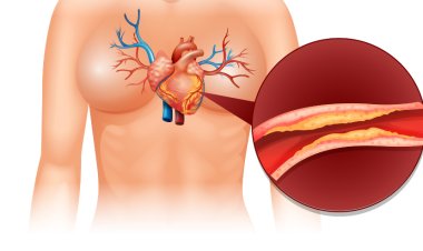 Understanding CT Coronary Angiography: Procedure, Uses, and Benefits