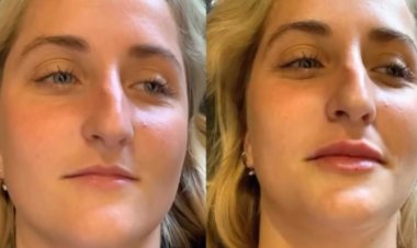 The Fillers Treatment Technique Celebrity Dermatologists Are Using to Reverse 10 Years of Aging