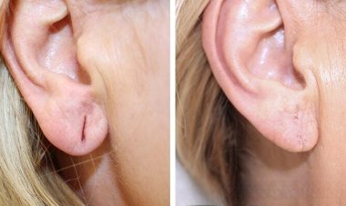 Earlobe Correction in Islamabad for Re-Piercing Preparation