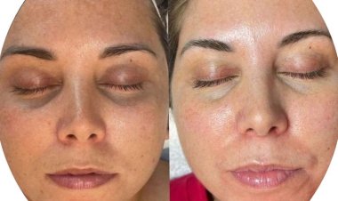 Hydrafacial in Islamabad: Achieve Clear and Glowing SkinThe Rise of Modern Facial Treatments