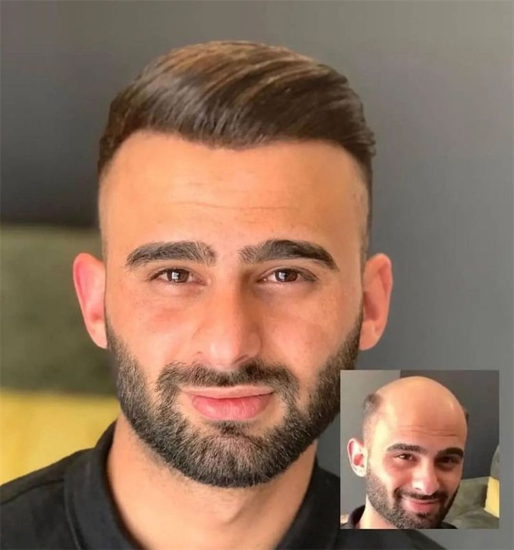 Hair Wig for Men for Confidence After Hair Loss