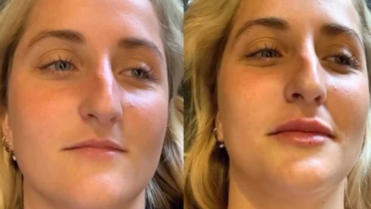 The Fillers Treatment Technique Celebrity Dermatologists Are Using to Reverse 10 Years of Aging