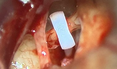 Restoring the Gift of Hearing: 2,000+ Lives Reconnected Through Advanced Micro Ear Surgery (Stapedotomy) at CARE Hospitals