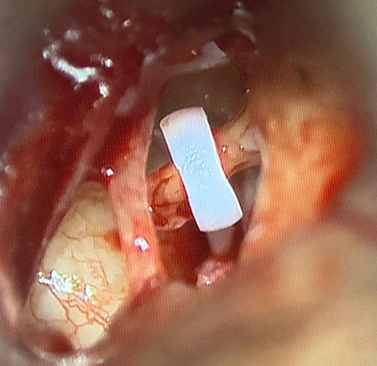 Restoring the Gift of Hearing: 2,000+ Lives Reconnected Through Advanced Micro Ear Surgery (Stapedotomy) at CARE Hospitals