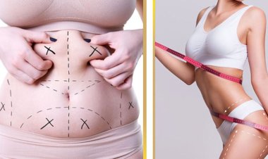 How Age Affects Liposuction Results in Islamabad