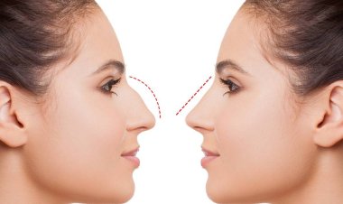 Rhinoplasty in Islamabad and modern aesthetic expectations