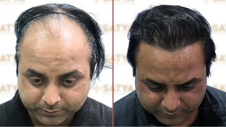 Best Hair Transplant Clinic in India: Your Guide to Natural Hair Restoration at Satya