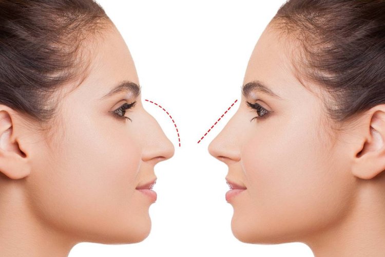 Rhinoplasty in Islamabad and modern aesthetic expectations