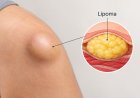 What Happens If You Leave a Lipoma Untreated for Years?