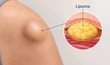 What Happens If You Leave a Lipoma Untreated for Years?